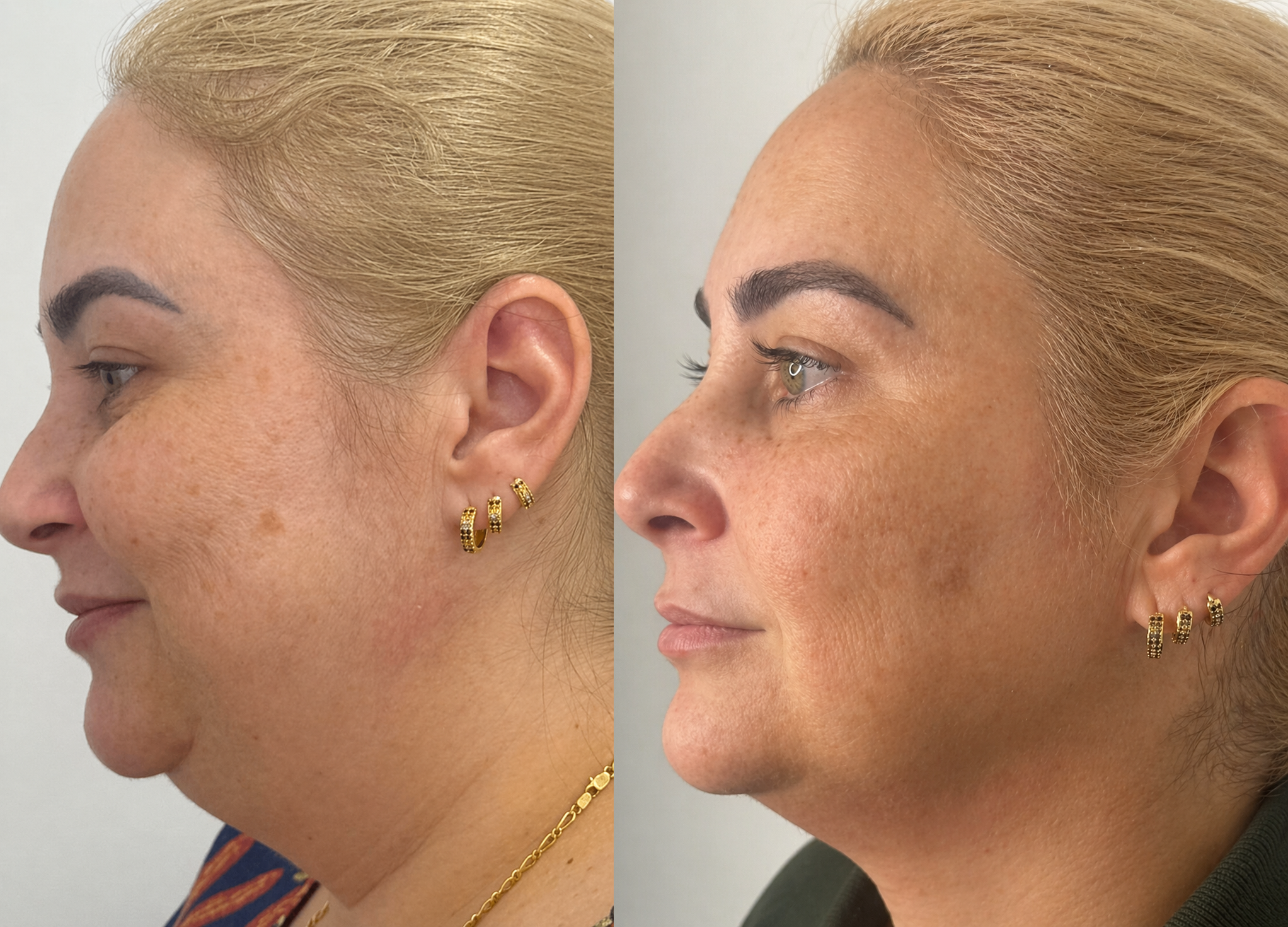 Resultado antes e depois 7